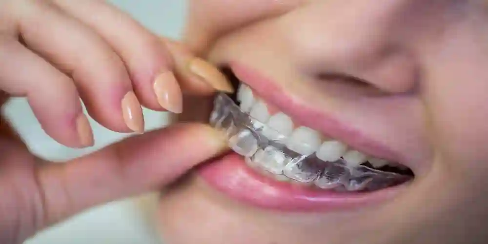 Orthodontic Correction